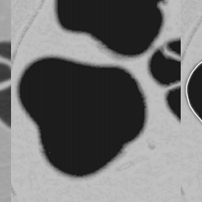 Manual segmentation compared to computed cleansing. 