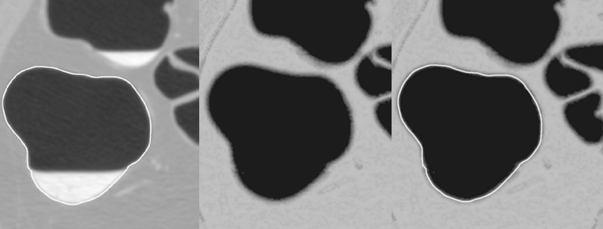 Manual segmentation compared to computed cleansing. 