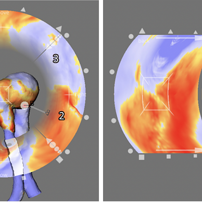 A 3D model of the relevant vascular anatomy is surrounded by map views that display scalar flow features of five sides (features at the left, right, bottom, and up side are shown at the corresponding ring portions). Scalar features of the backside are shown at the most right display. The lines pointing from the map portions to the 3D view indicate correspondences, where scalar features are shown in both views. If the user drags a point, representing an interesting feature from a map view to the center, the anatomical model is rotated to make that region visible. All map views change accordingly.