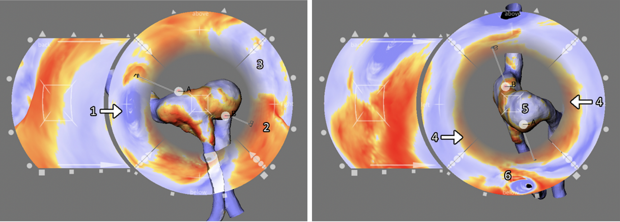 A 3D model of the relevant vascular anatomy is surrounded by map views that display scalar flow features of five sides (features at the left, right, bottom, and up side are shown at the corresponding ring portions). Scalar features of the backside are shown at the most right display. The lines pointing from the map portions to the 3D view indicate correspondences, where scalar features are shown in both views. If the user drags a point, representing an interesting feature from a map view to the center, the anatomical model is rotated to make that region visible. All map views change accordingly.
