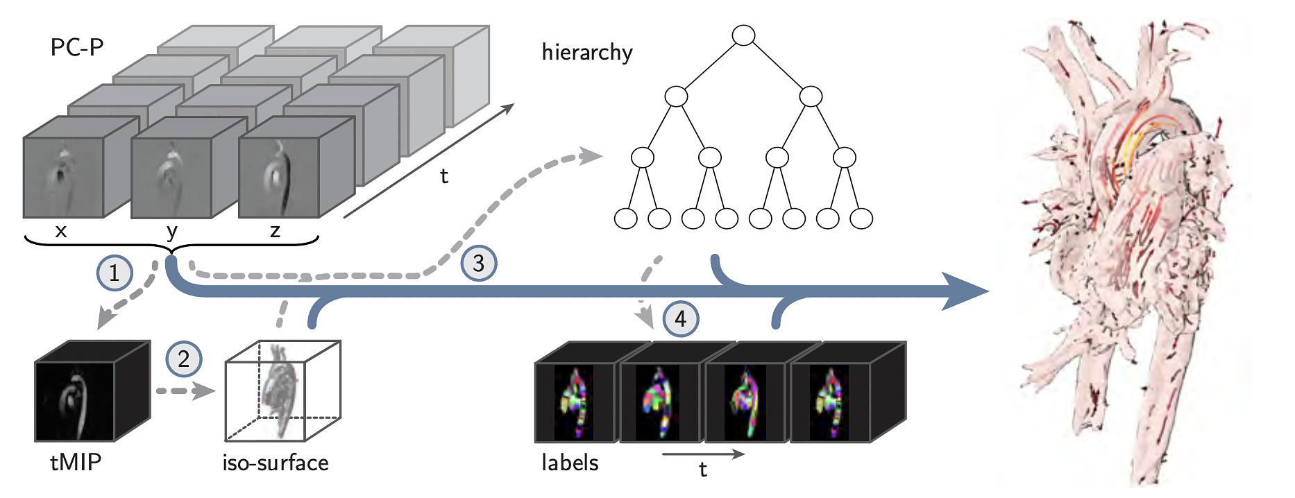 Overview of the visualization framework, based on spatiotemporal hierarchical clustering. The gray dashed arrows depict pre-processing steps. (1) A tMIP volume is generated, and (2) an iso-threshold captures the voxels that are clustered. (3) Next, the cluster hierarchy is constructed. (4) Using the cluster tree, labels are generated per cardiac phase. After preprocessing, the real-time visualization is generated using the available data structures, as depicted by the solid blue arrow.