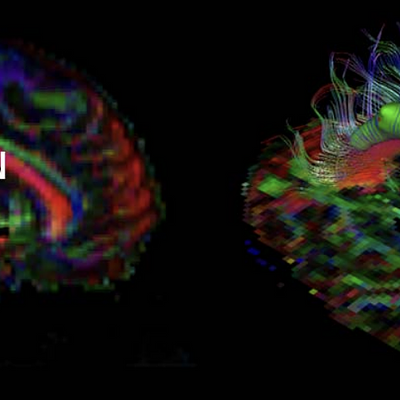 Left cingulum segmented with estimated wFA=0.8 and w for a 128x128x66 DT volume. Left: P – positive region; N – negat region. 