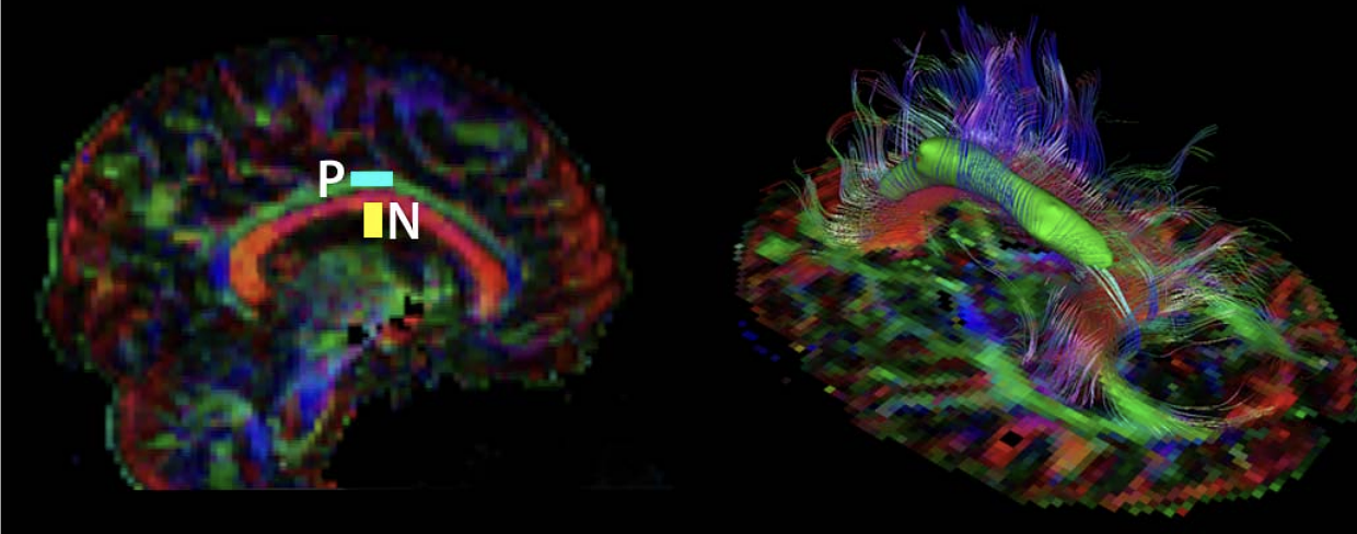 Left cingulum segmented with estimated wFA=0.8 and w for a 128x128x66 DT volume. Left: P – positive region; N – negat region. 