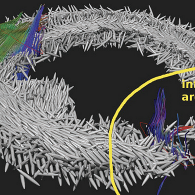 Our new rendering method using ellipsoids with fixed shape to show the fibre orientations in the cross section of an infarcted heart, which was scanned 28 days after the infarct. We also tracked fibres from two different seeding areas. The resulting fibres were rendered as thin tubes and RGB colouring of the fibre orientation was used.