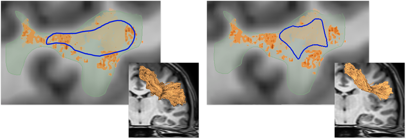Fiber Tracking Region and Sensitivity Visualization